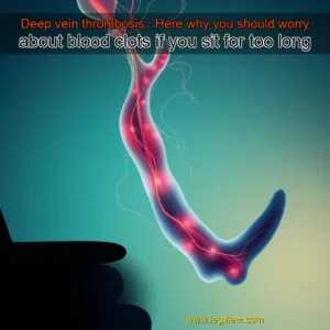 Read more about the article Deep vein thrombosis : Here why you should worry about blood clots if you sit for too long