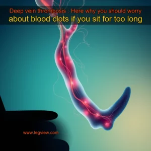 Read more about the article Deep vein thrombosis : Here why you should worry about blood clots if you sit for too long