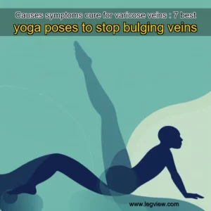 Read more about the article Causes  symptoms  cure for varicose veins : 7 best yoga poses to stop bulging veins