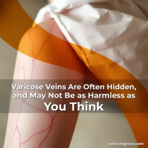 Read more about the article Varicose Veins Are Often Hidden, and May Not Be as Harmless as You Think